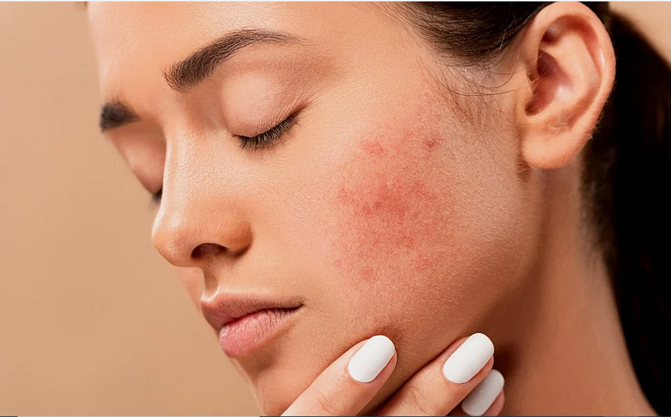 eczema